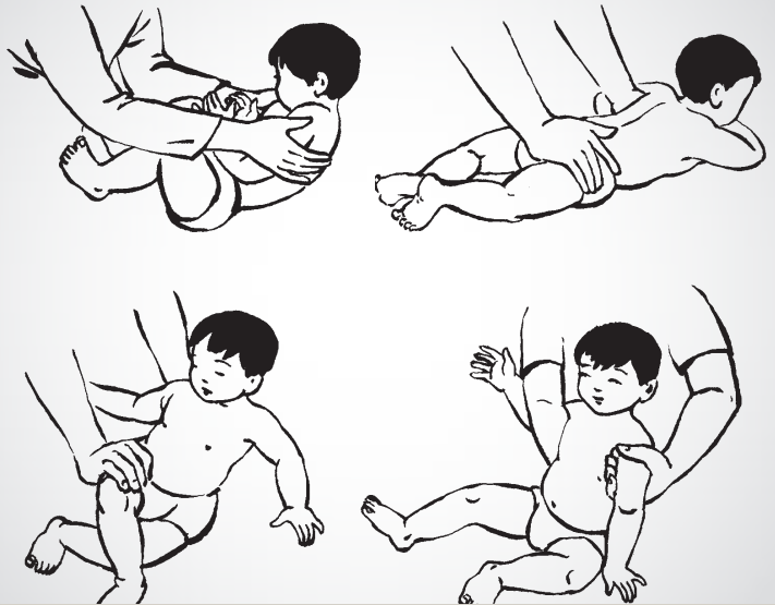 Phục hồi chức năng bàn chân khoèo bẩm sinh
